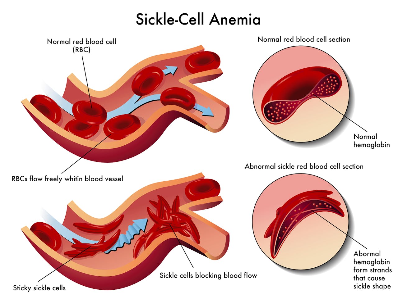 Qué es anemia falciforme