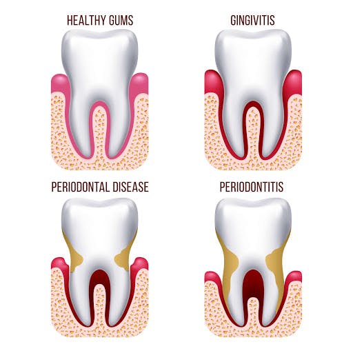 Gingivitis periodontitis