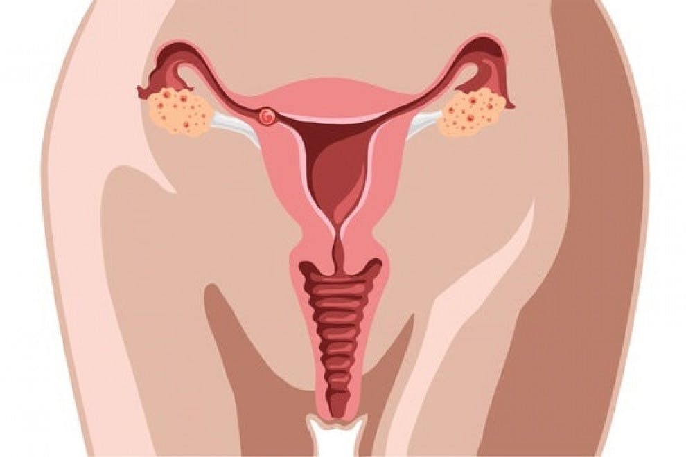 Cáncer de cuello uterino