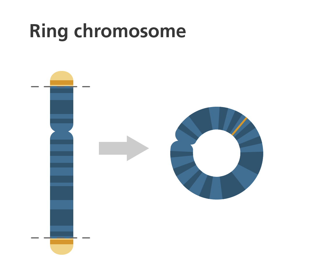Кольцевая хромосома. Кольцевая хромосома генетика. Ring хромосомы. Кольцевая хромосома мутация.