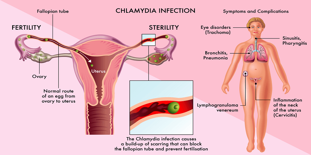 Chlamydia complications