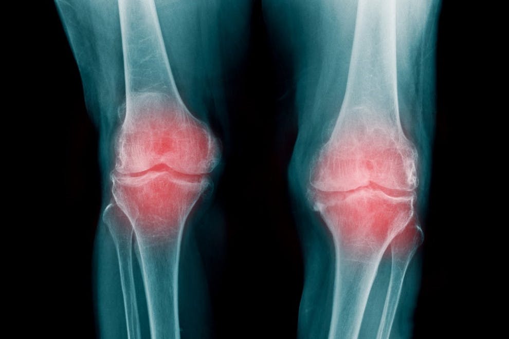 Diferencias artrosis y artritis