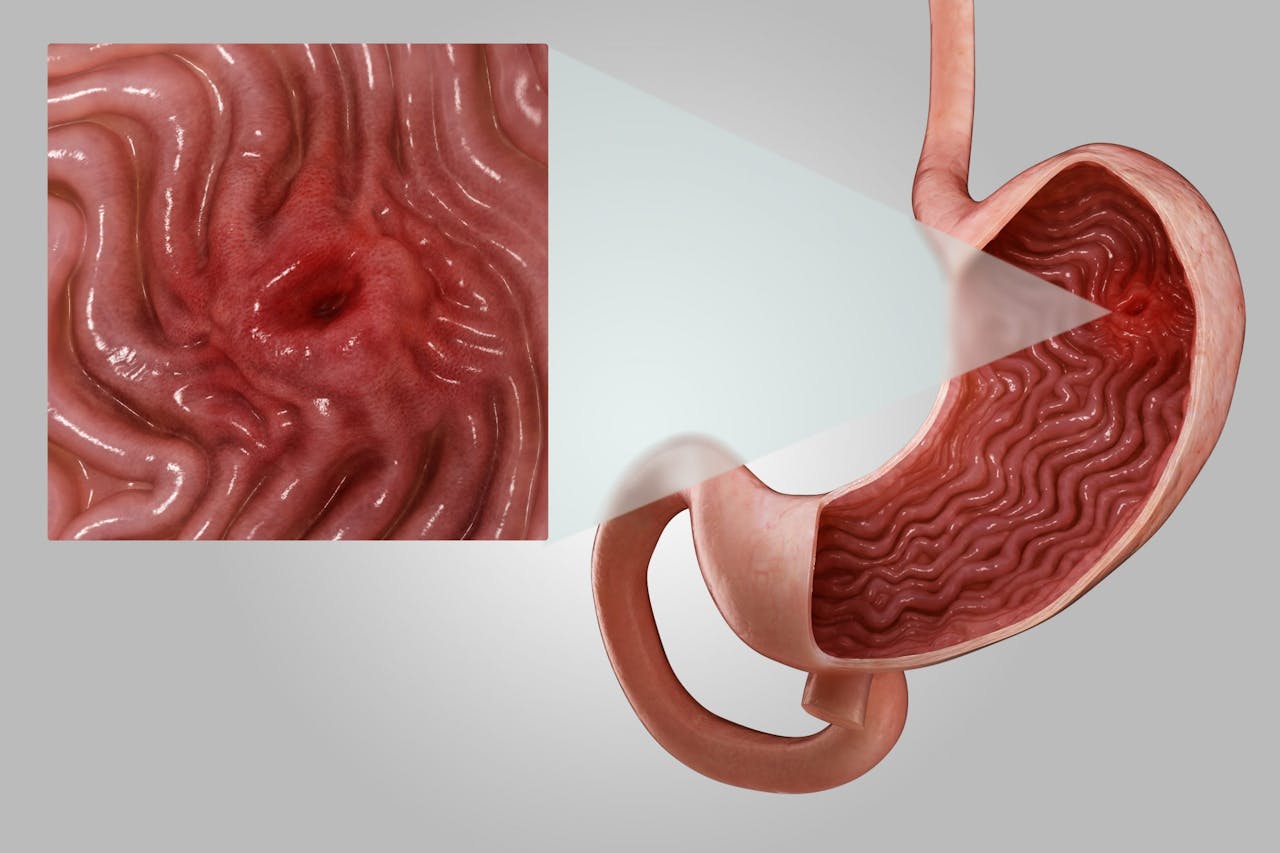 Úlcera gástrica