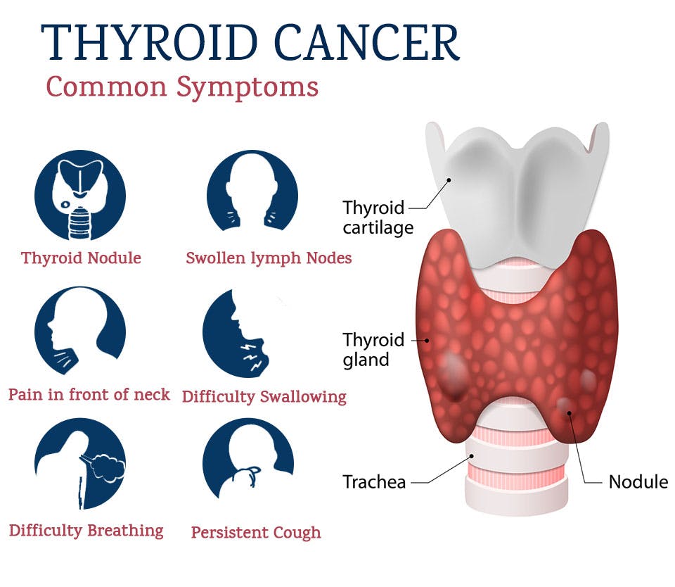 Síntomas cáncer tiroides