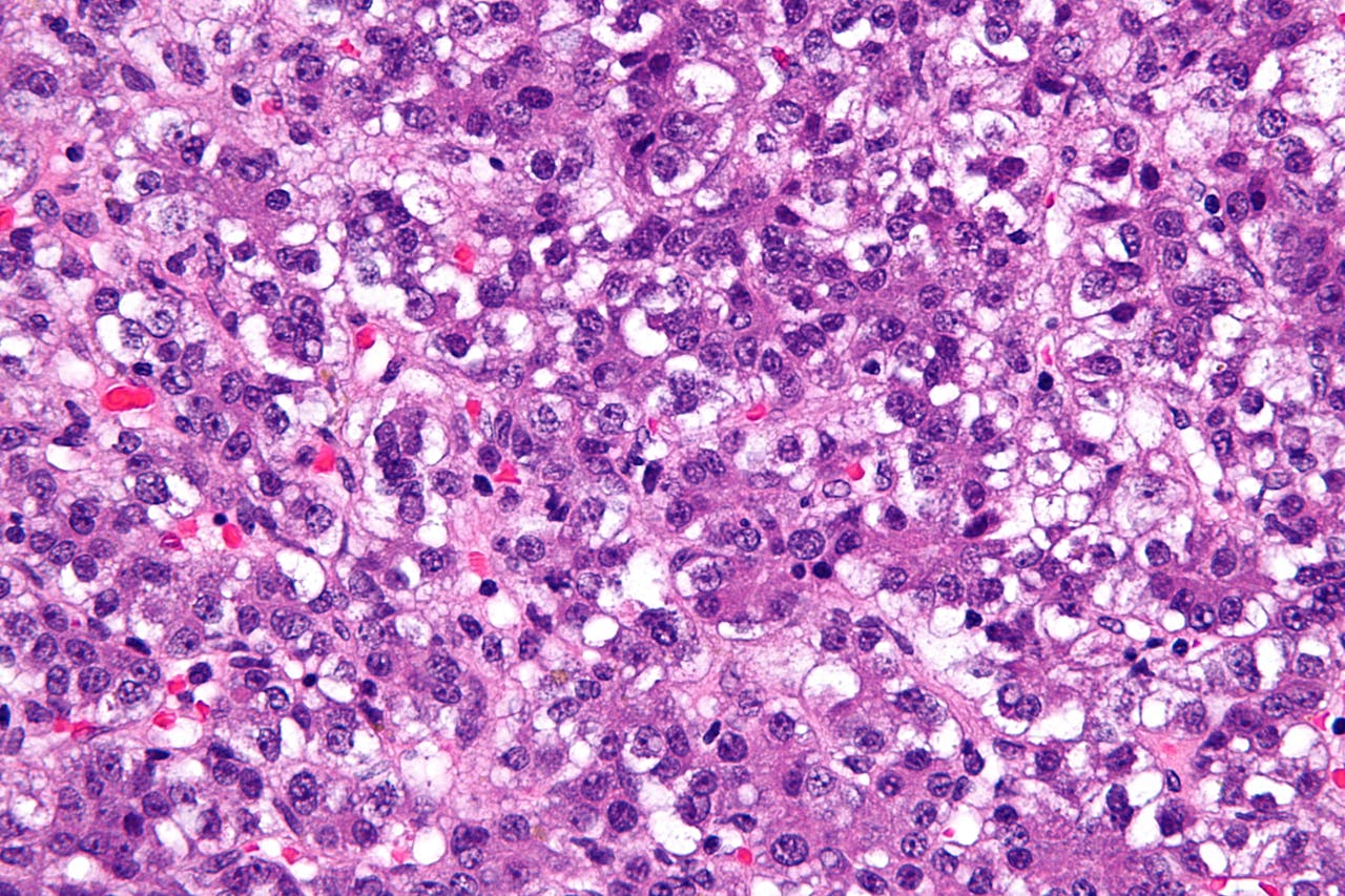 Causas hepatoblastoma