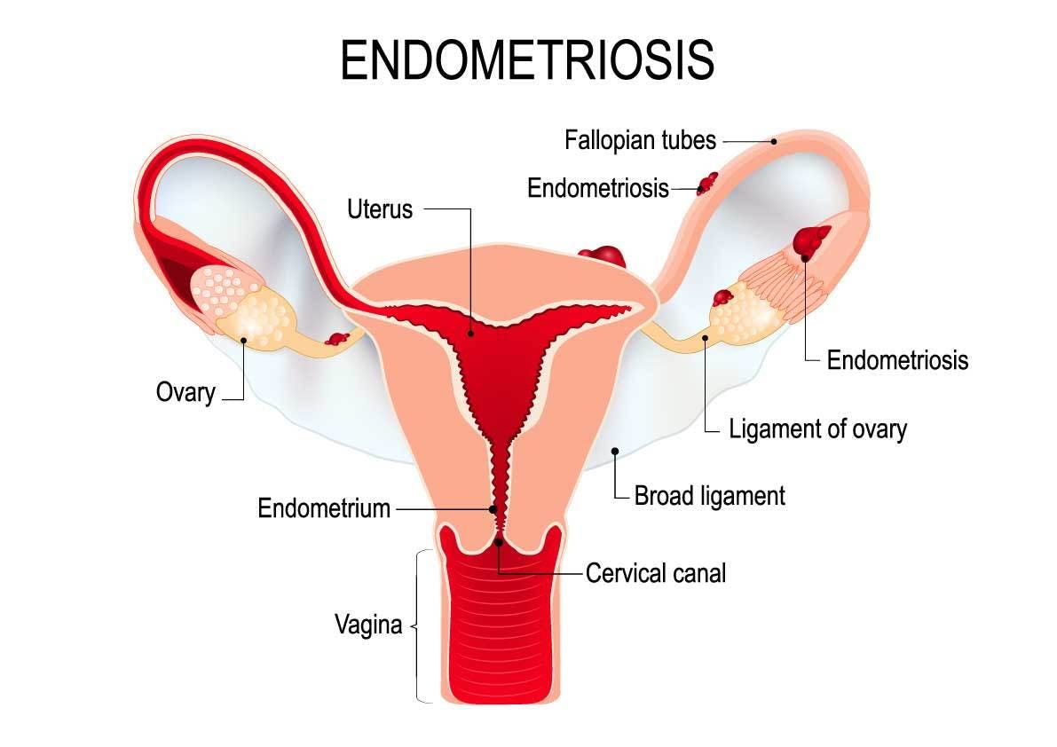 Qué es endometriosis