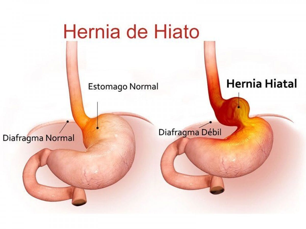 Hernia hiatal