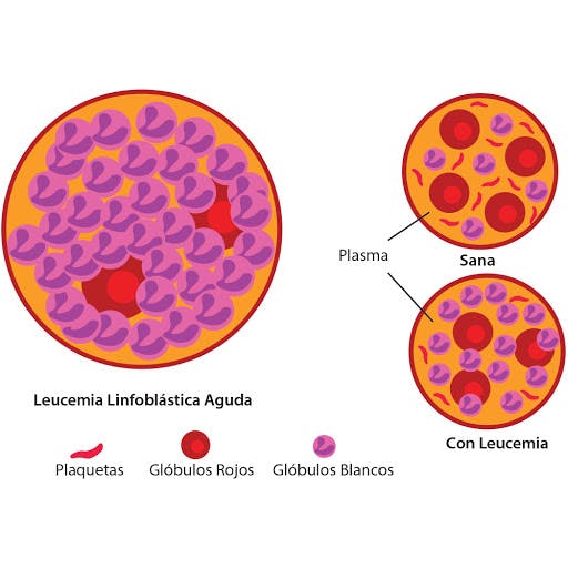 Leucemia linfocítica aguda