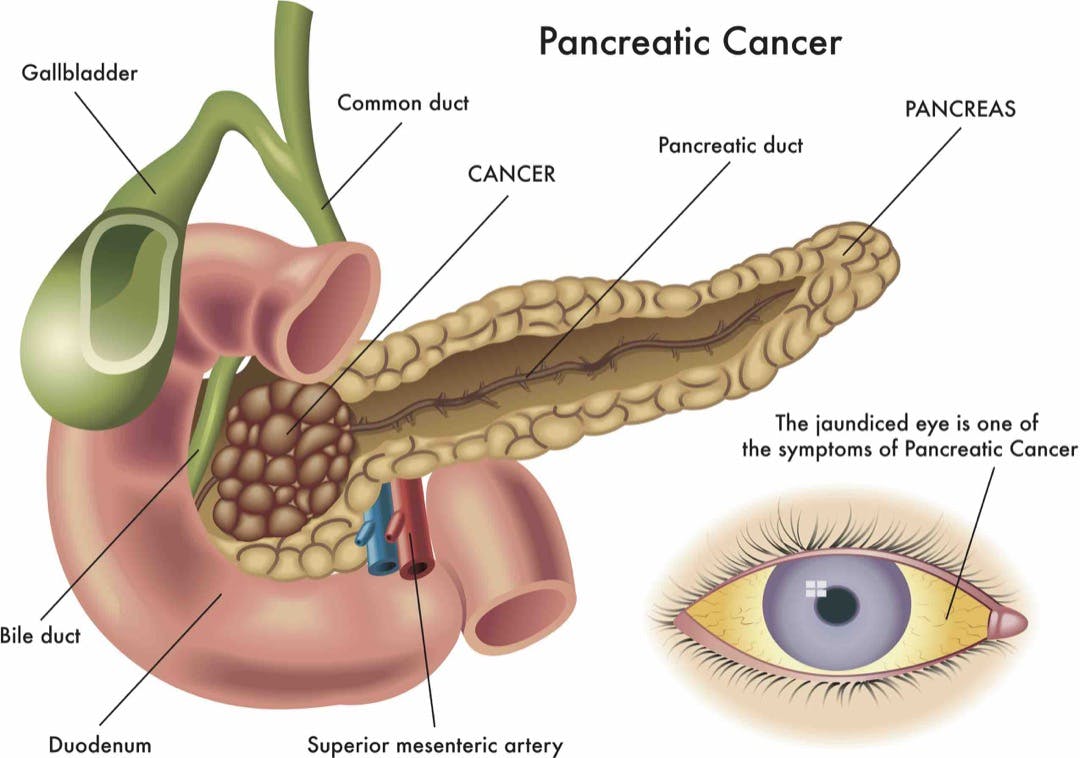 Cáncer pancreático