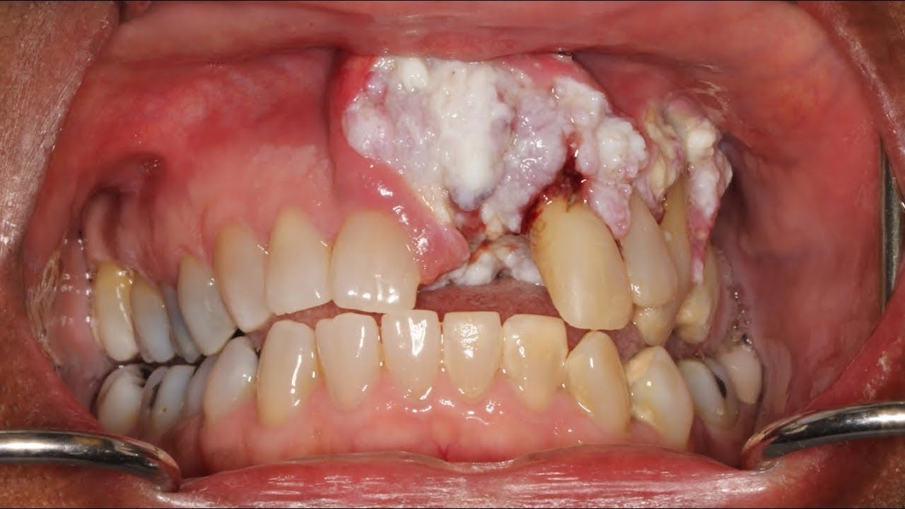 Síntomas cáncer boca