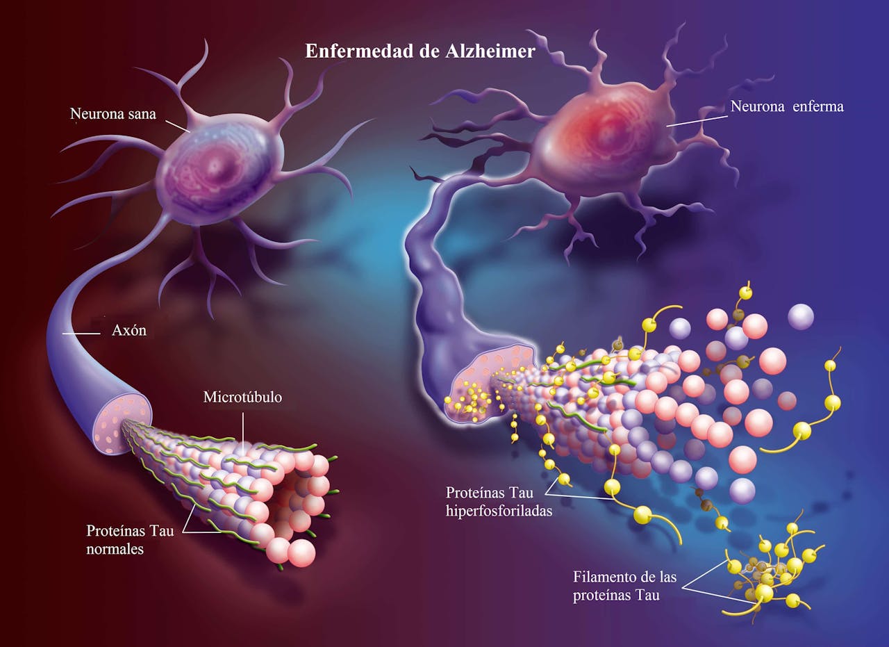 Alzheimer neuronas