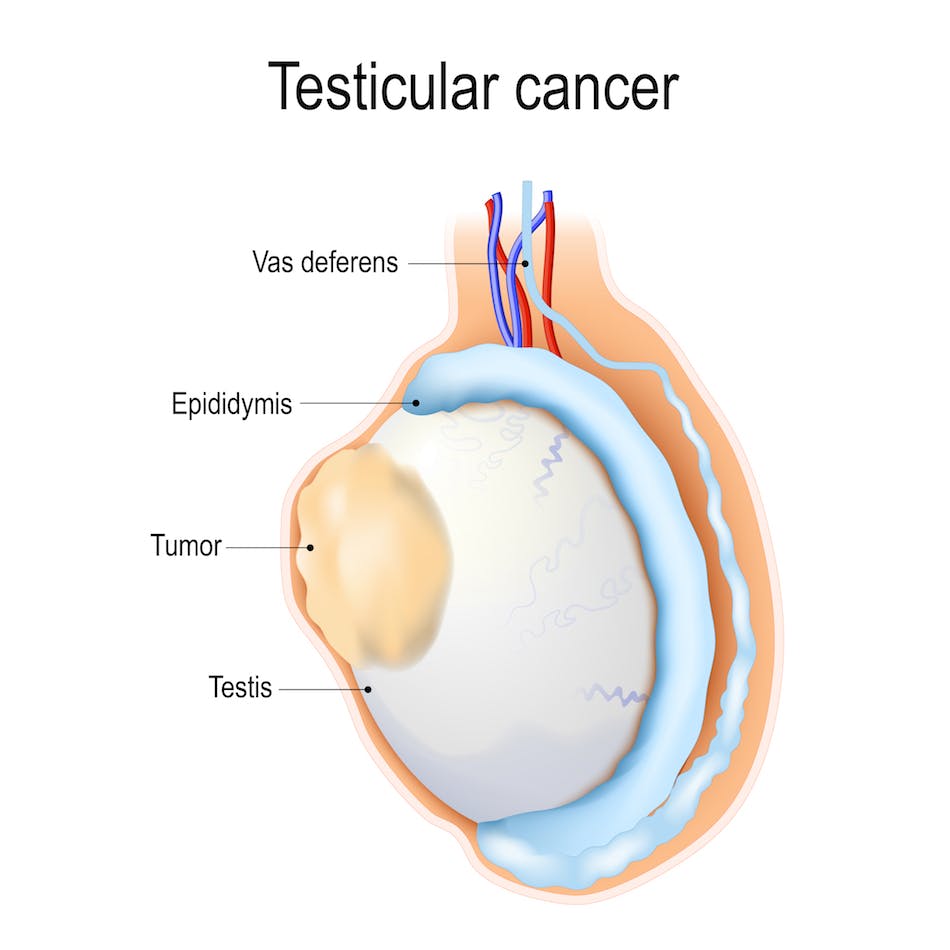 Cáncer testicular