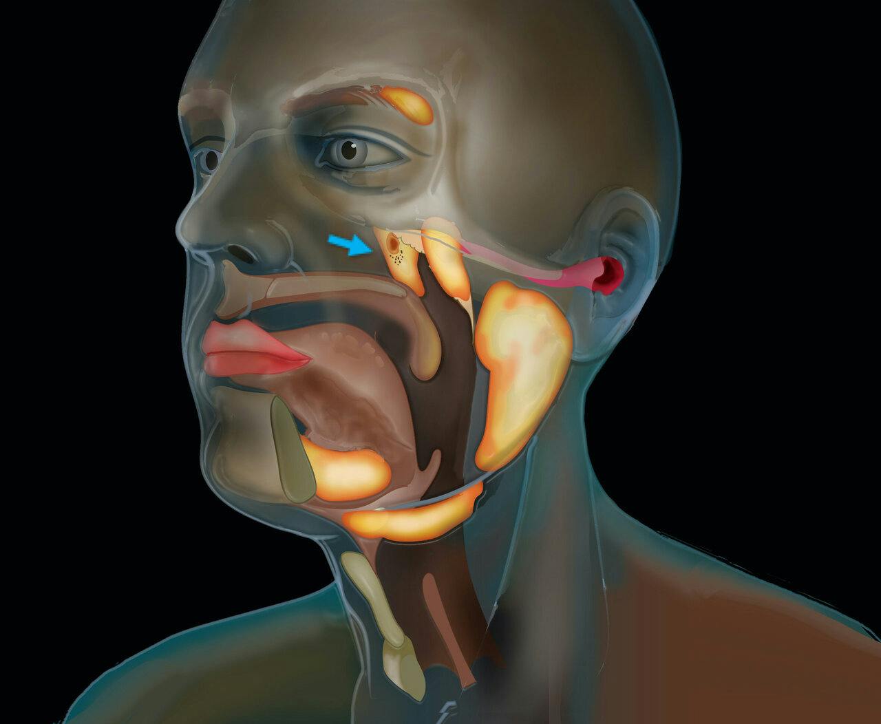Glándulas salivares cáncer