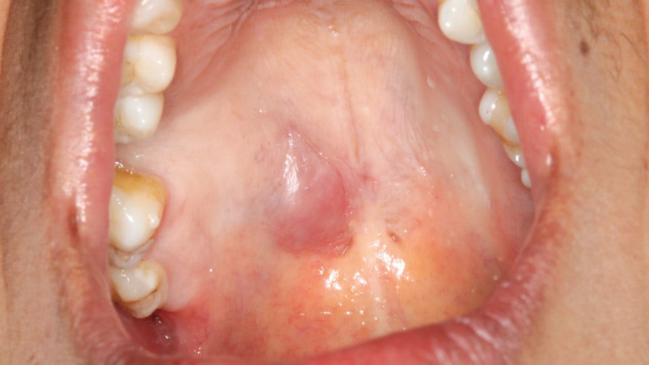 Cáncer glándulas salivales síntomas