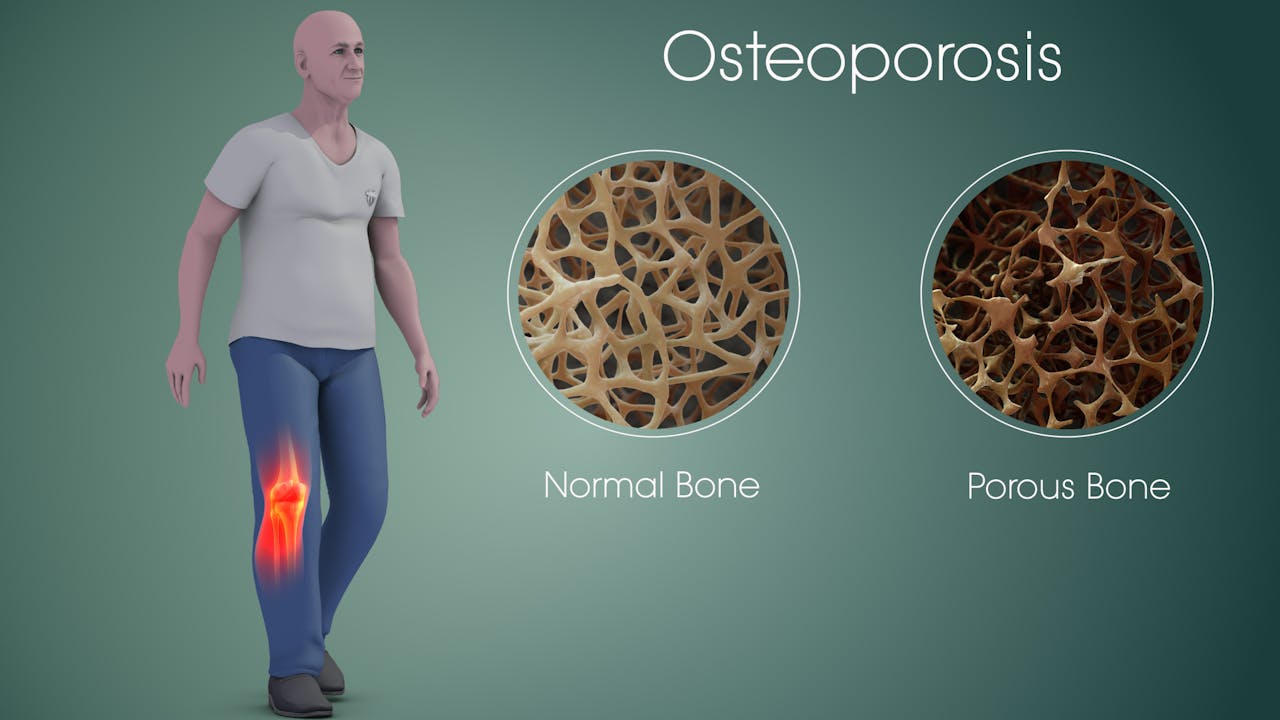 Qué es osteoporosis