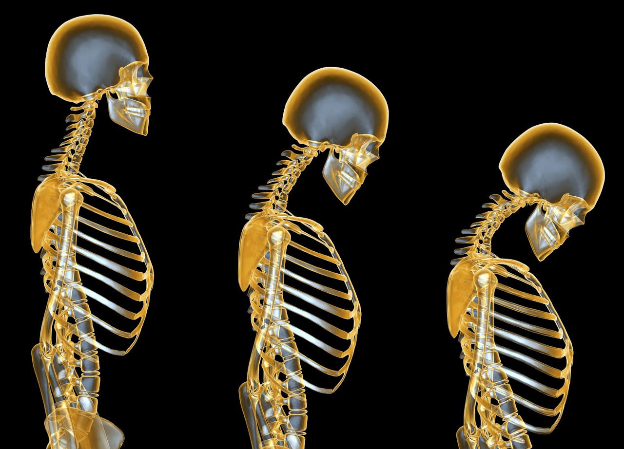 Síntomas osteoporosis