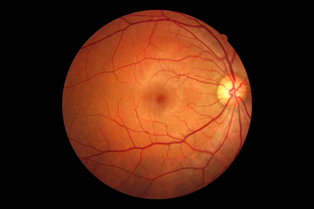 Causas desprendimiento retina