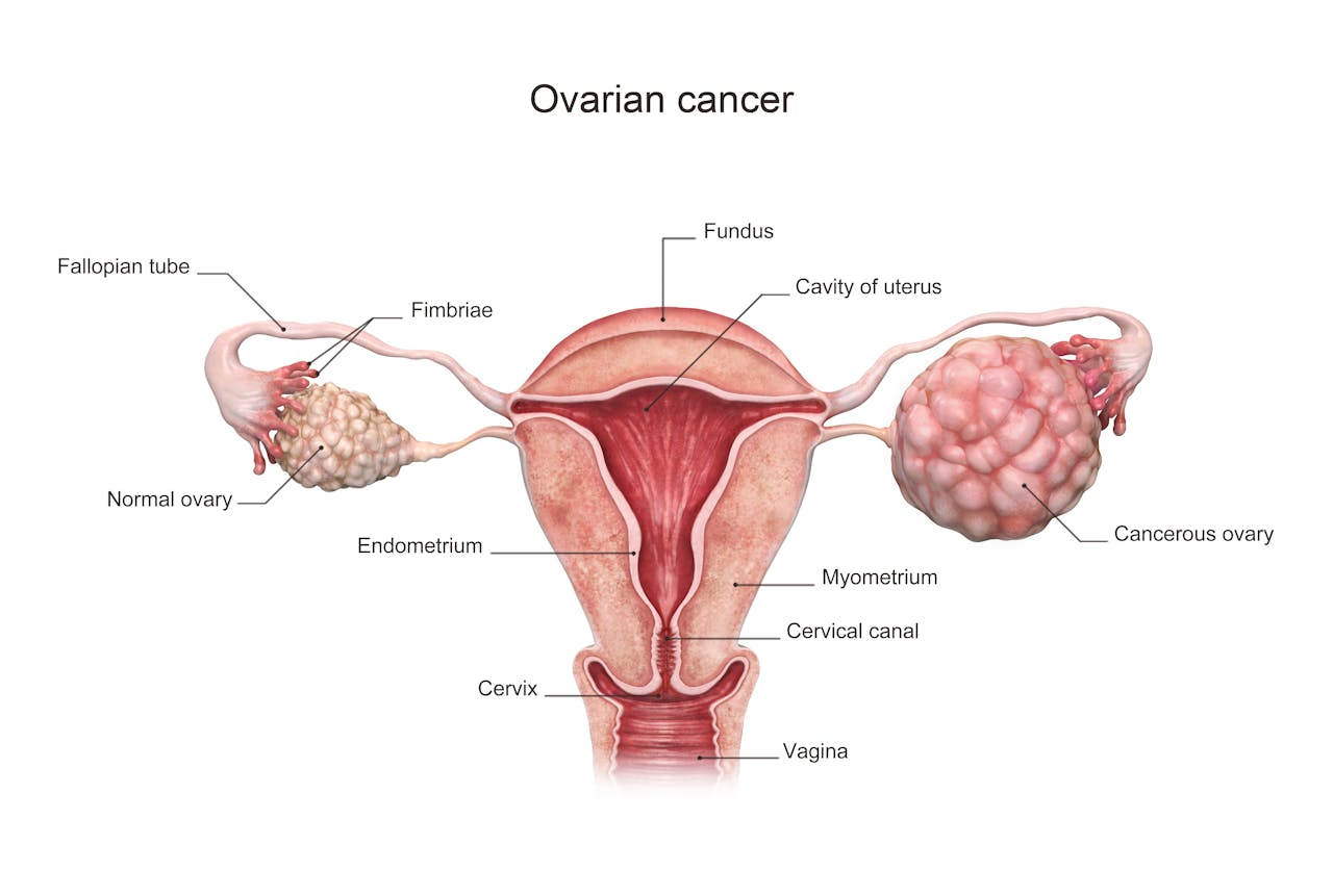 Cáncer ovario causas
