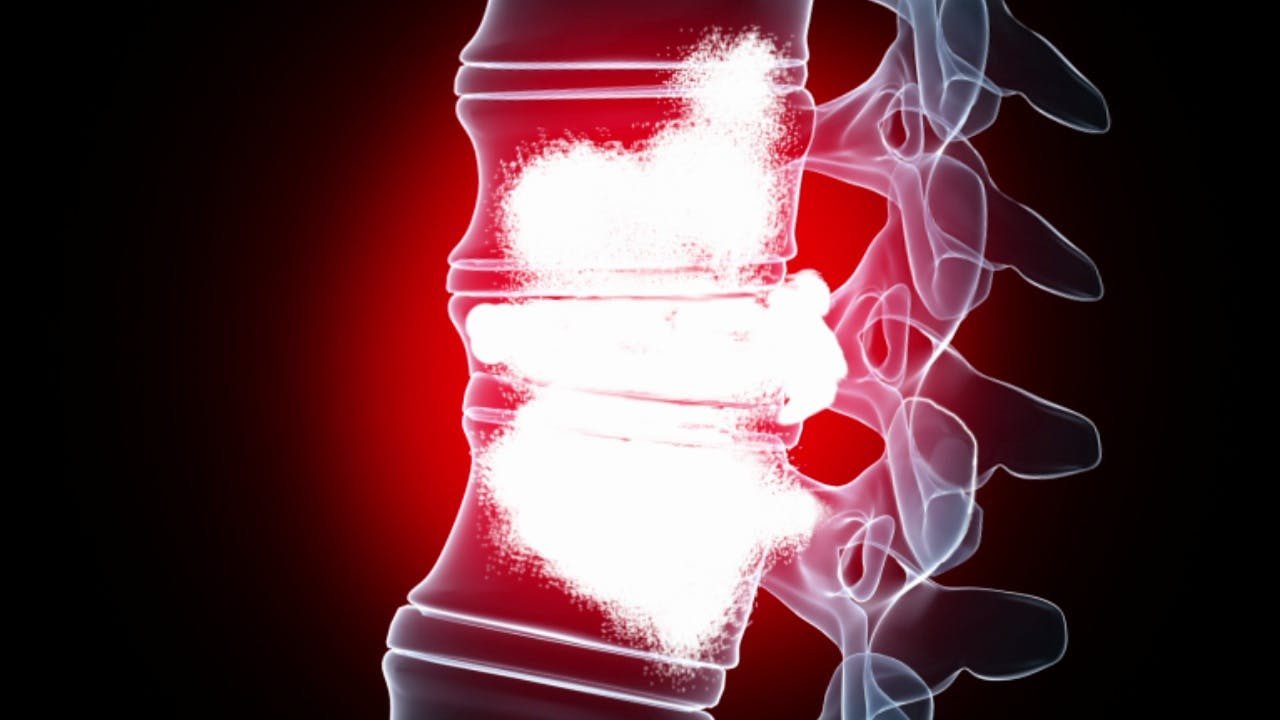 Cáncer médula espinal