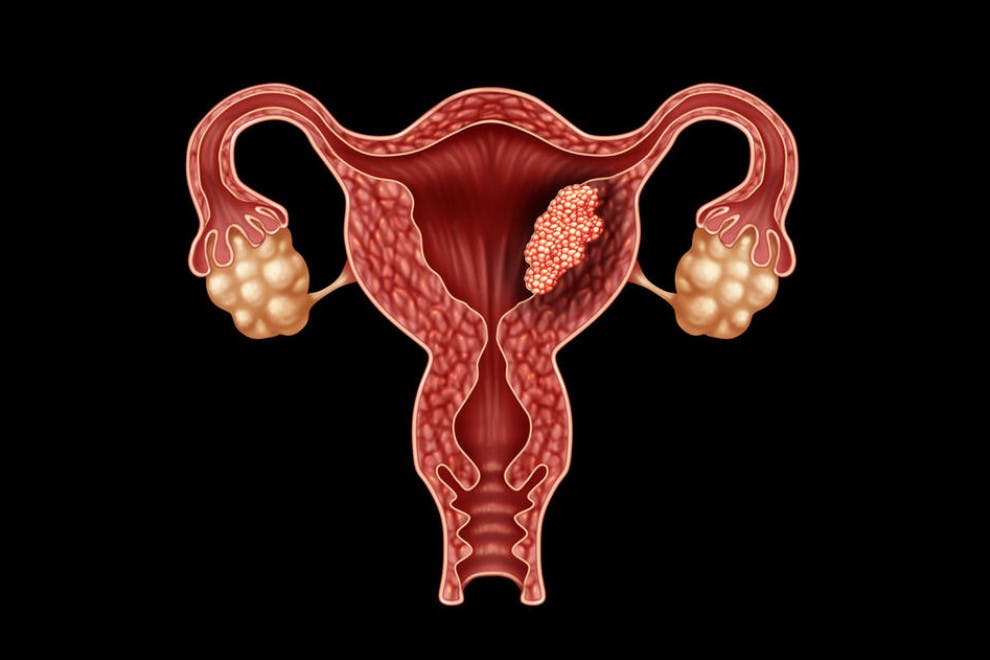 Cáncer endometrio