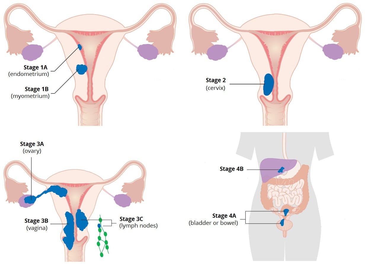 Qué es cáncer endometrio