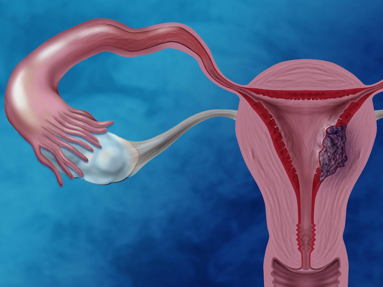 Cáncer endometrio causas