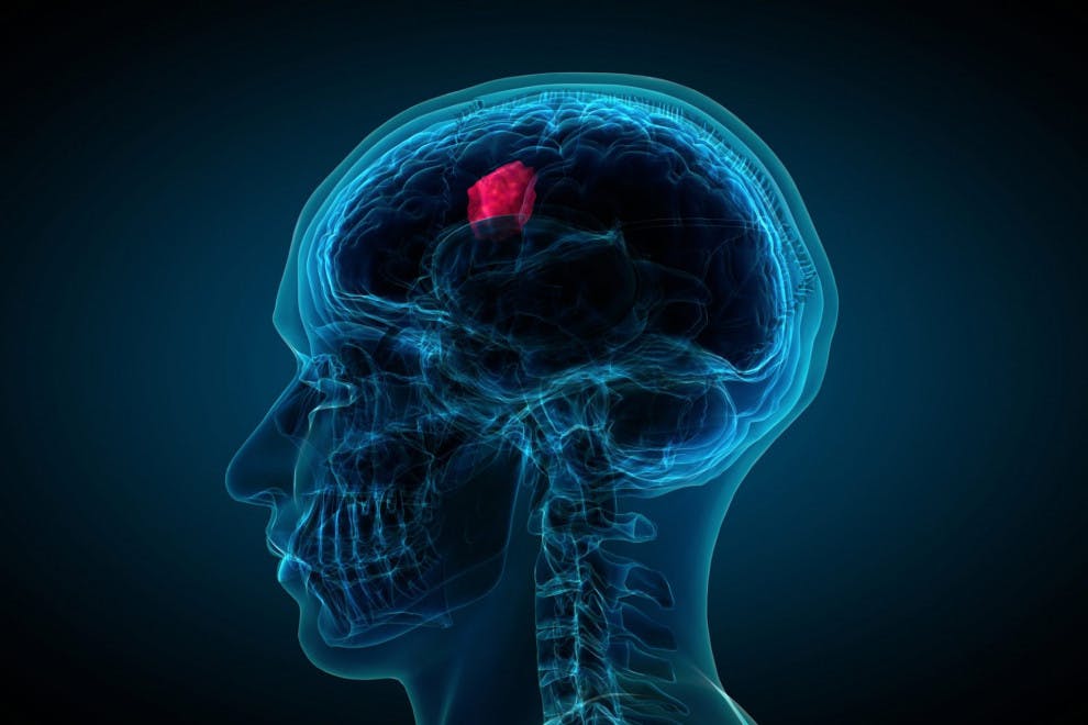 Tipos tumores cerebrales