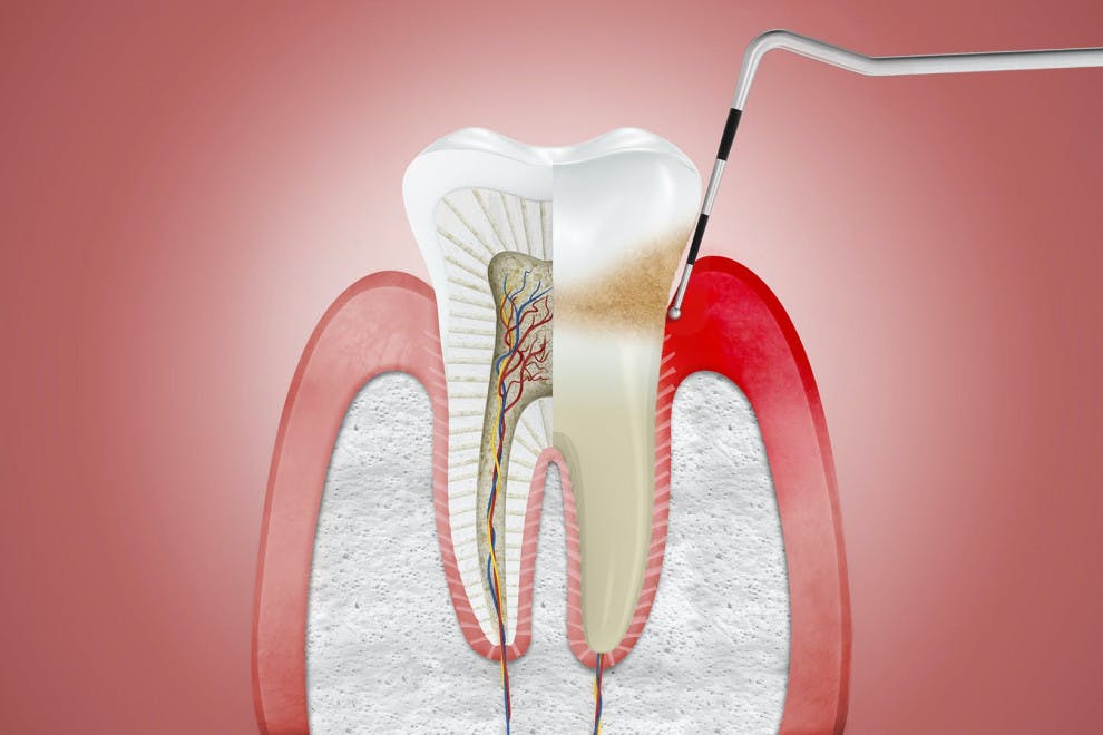 Diferencias gingivitis periodontitis