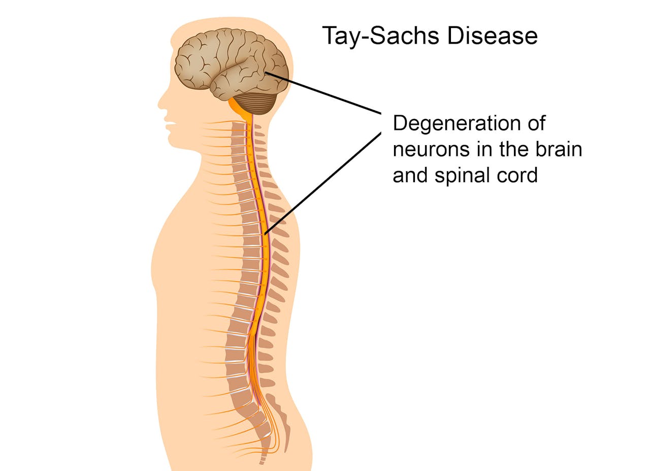 Qué es enfermedad Tay-Sachs