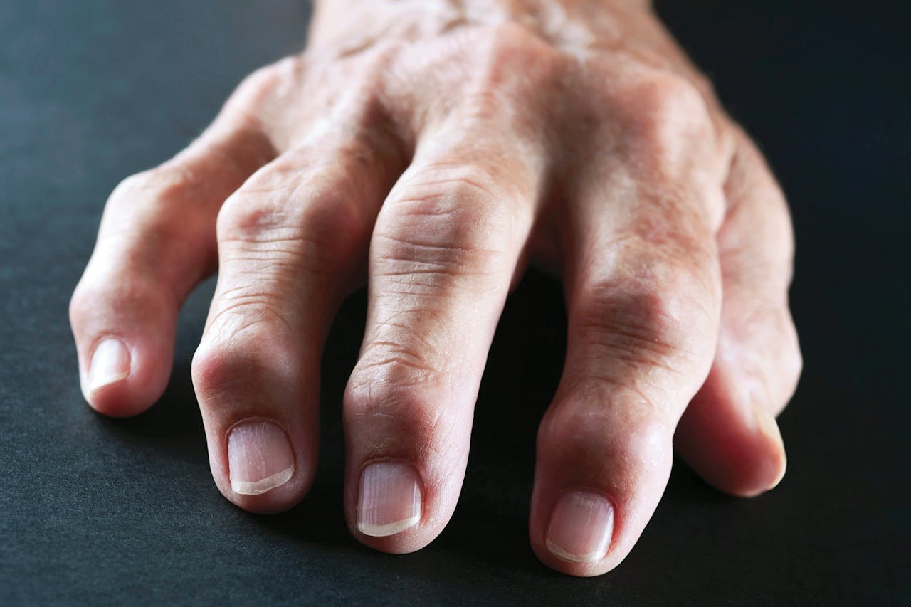 Qué es artritis reumatoide