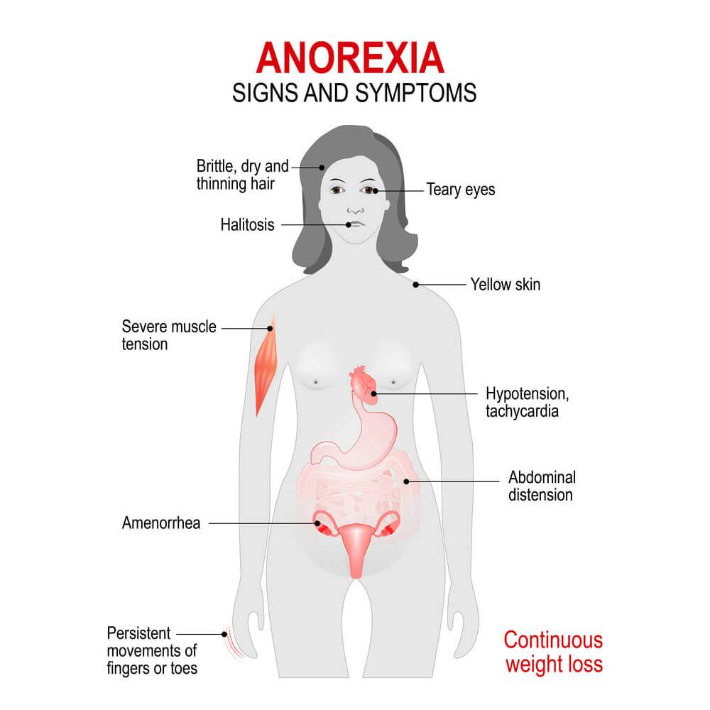 Síntomas anorexia