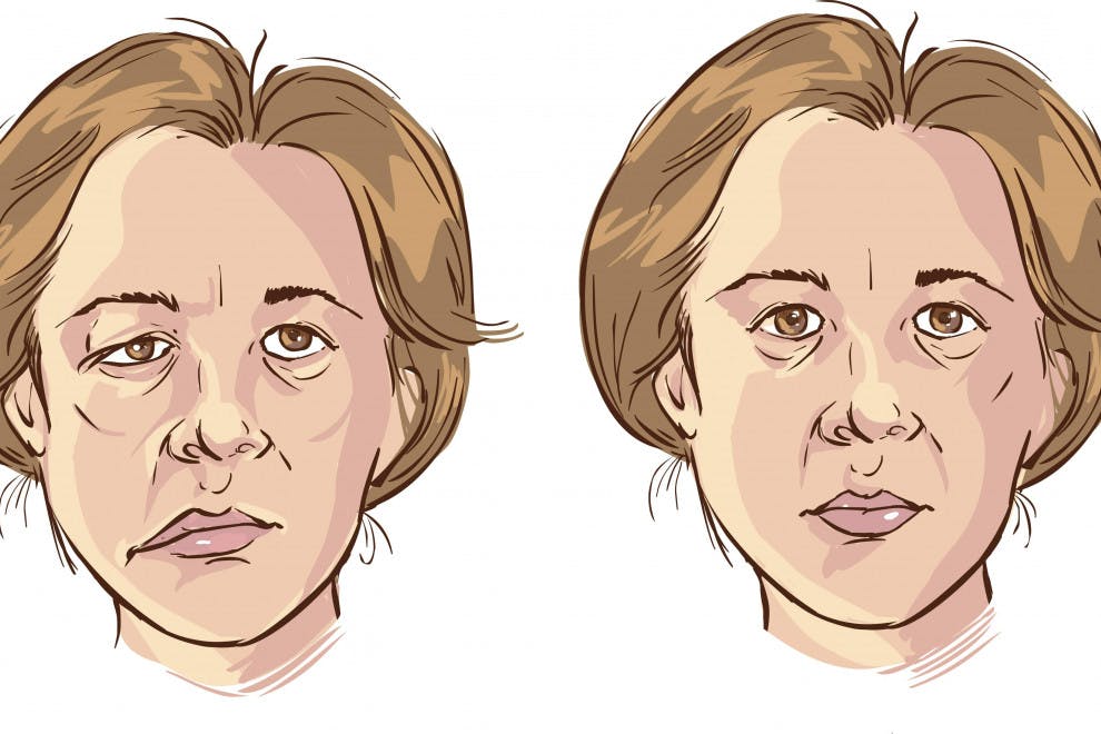 Diferencias parálisis facial central periférica