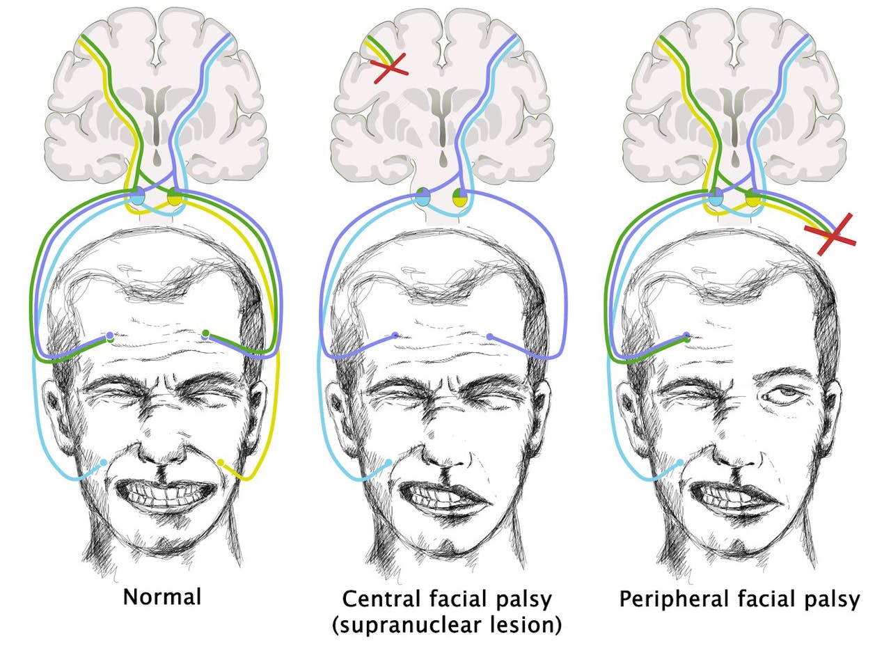 Parálisis facial periférica