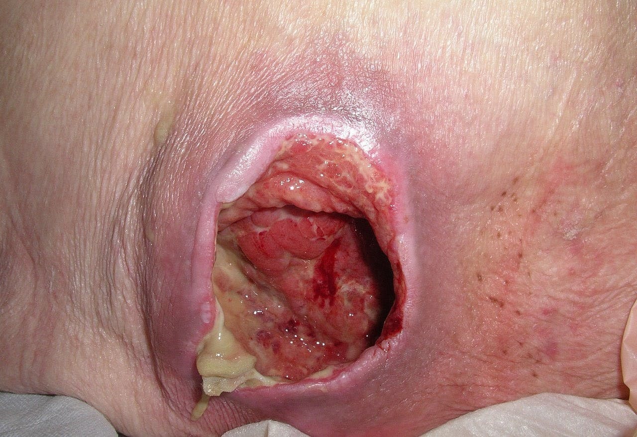 Qué es úlcera decúbito