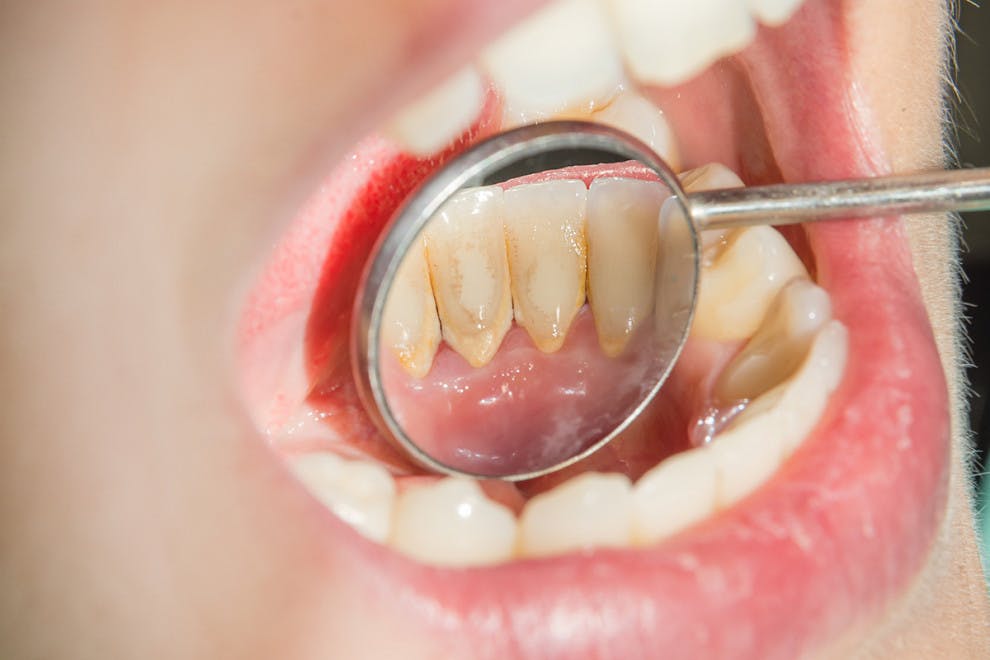 Diferencias placa dental sarro
