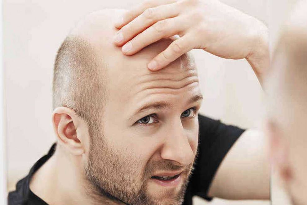 Tipos alopecia
