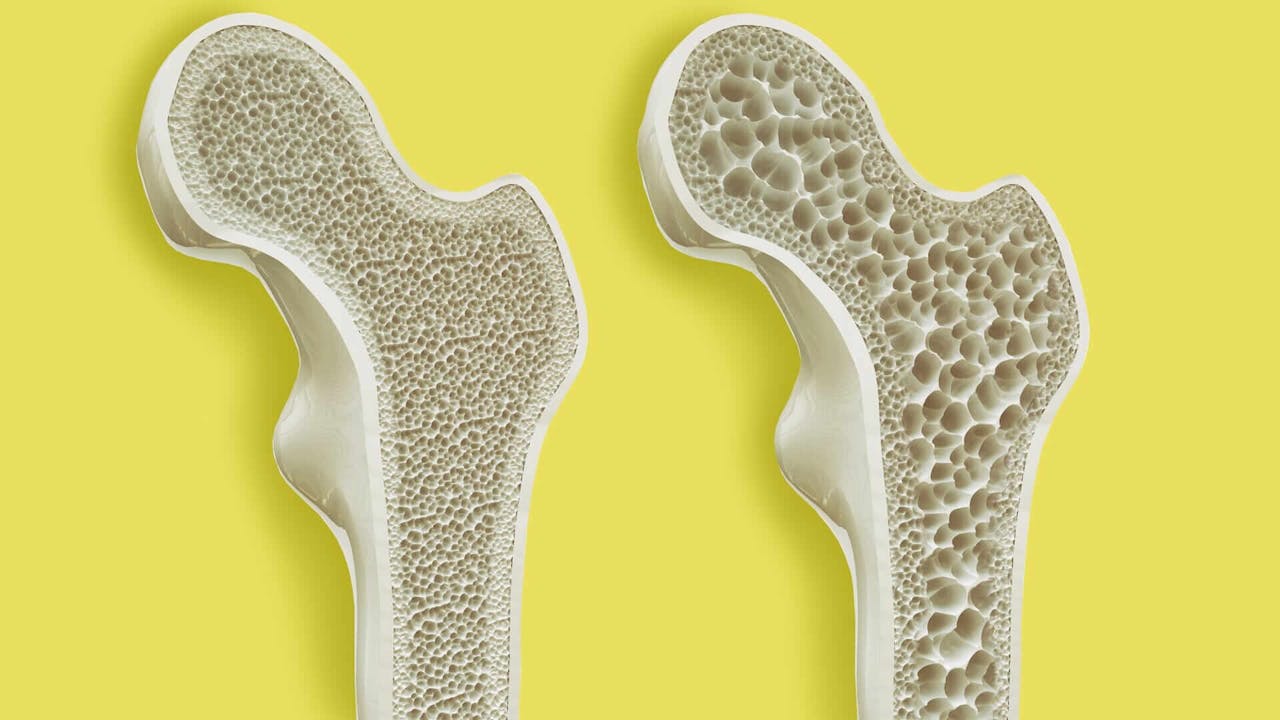 osteoporosis-artrosis
