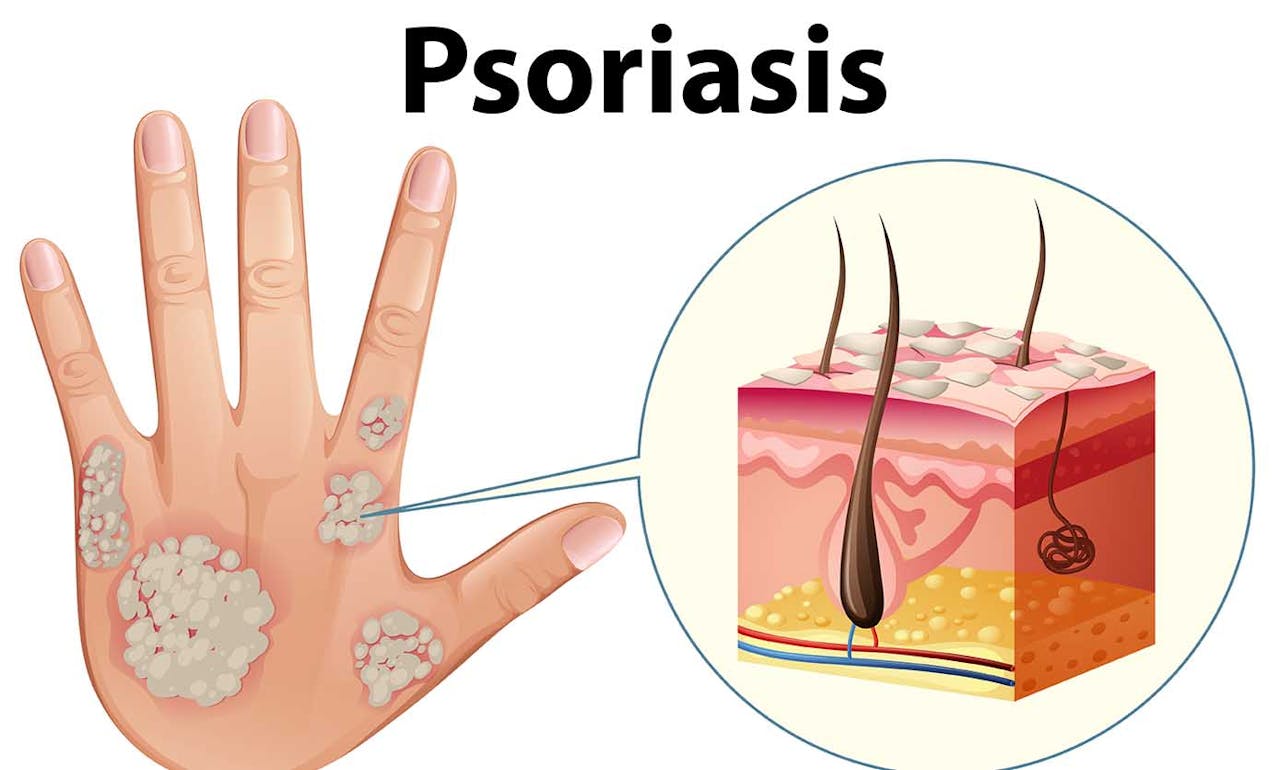 causas-psoriasis