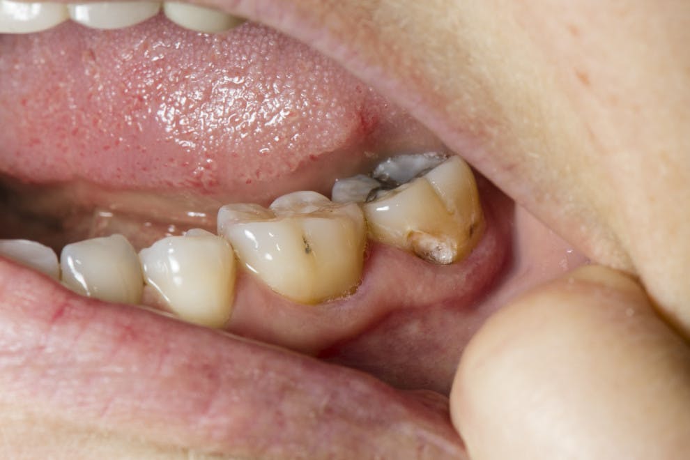 absceso-dental