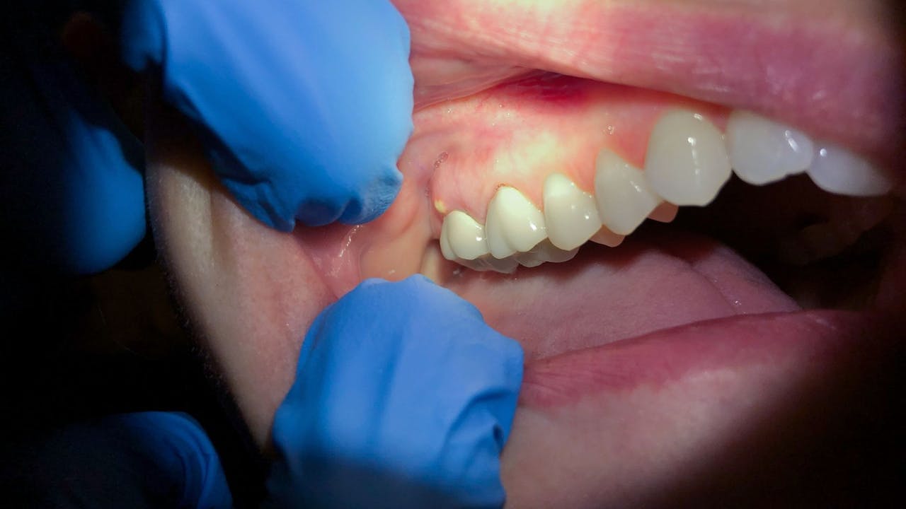 tratamiento-absceso-dental
