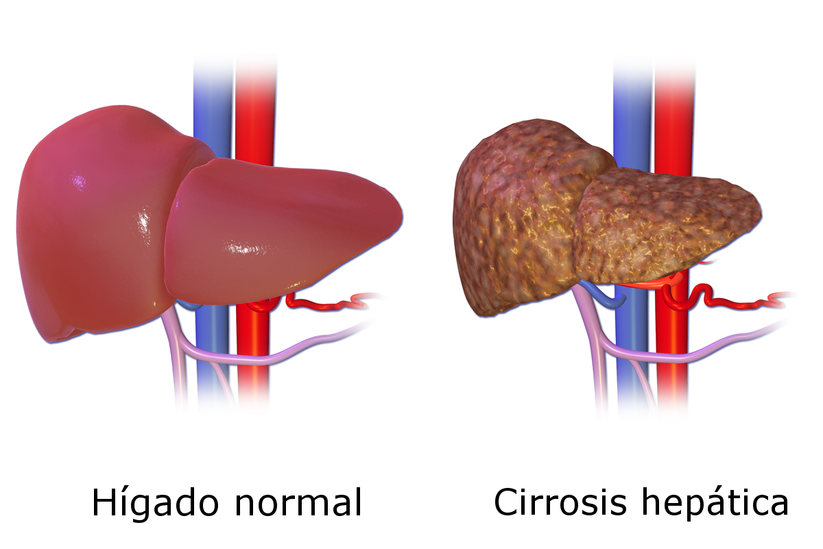 que-es-cirrosis-hepatica